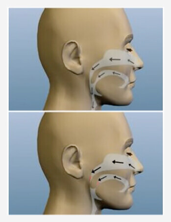 Sleep Apnea diagram