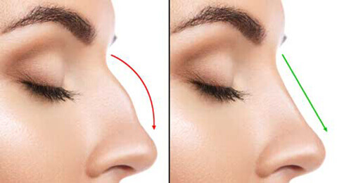 Rhinoplasty before and after
